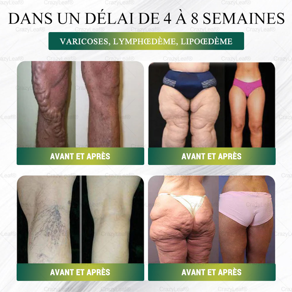 CANADA Cliniquement prouvé | Boutique officielle | Patch nano à microneedles CrazyLeaf® SMGT-GLP-1 avec collagène et Matrixyl 3000 | Cible : obésité, peau relâchée, hypertension, diabète, foie gras, douleurs articulaires, brouillard cérébral, fatigue